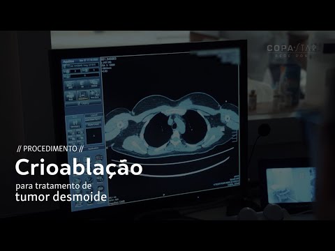 REDE D'OR | Copa Star:  Dr. Leonardo Azevedo explica como funciona a Crioablação