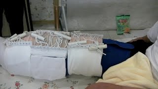 Case Study 540432: Gigantic Lymphedema by Twisting Tourniquet Technique วิธีขันชะเนาะลดบวม Case Study 540432: Gigantic Lymphedema by Twisting Tourniquet Technique วิธีขันชะเนาะลดบวม