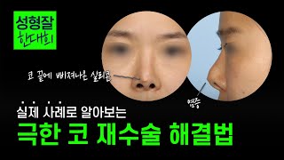 EDITION TV - 코수술 후 코끝에 실리콘 비침과 염증까지? 이렇게 해결했습니다!