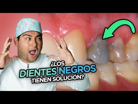¡EL SARRO DENTAL NEGRO! ¿QUE SIGNIFICA EL COLOR DEL CALCULO DENTAL Y COMO QUITARLO DE LOS DIENTES?