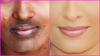 How To Get Rid of Dark and Dry Skin Around Mouth Naturally With Effective Home Remedies