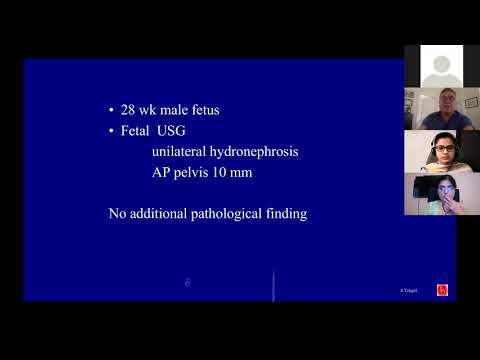 Dr. Serdar Tekgul & Dr. Hina Yousuf Webinar on Prenatal and Postnatal Hydronephrosis