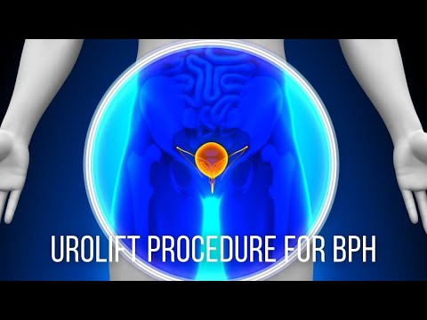 UroLift Procedure for BPH – Dr. David Harris