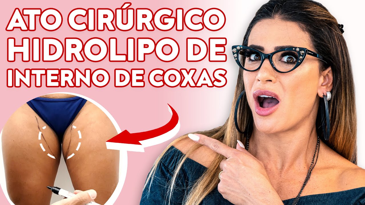 CIRURGIA HIDROLIPO DE INTERNO DE COXAS | LILI SPADA