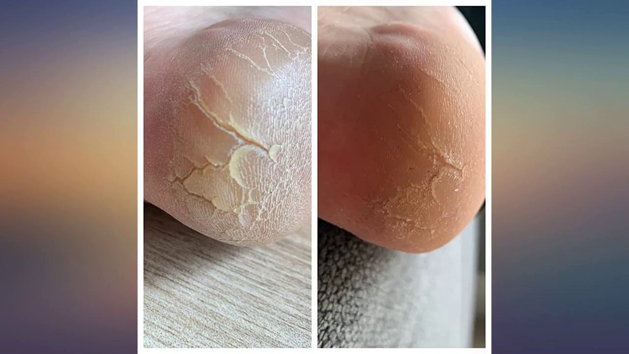 PurSources Urea 40% Foot Cream 4 oz - Best Callus Remover - Moisturizes & Rehydrates Thick