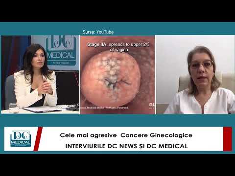 Cancere ginecologice: Prof Dr Elvira Brătilă la interviurile DC News și DC Medical