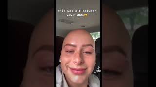 Life of Alopecia pt. 3: watch my hair fall out and then grow back again