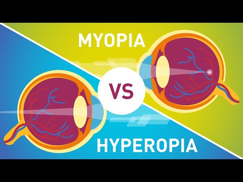 Myopia fordul elő hyperopia - Myopia vs. Hyperopia