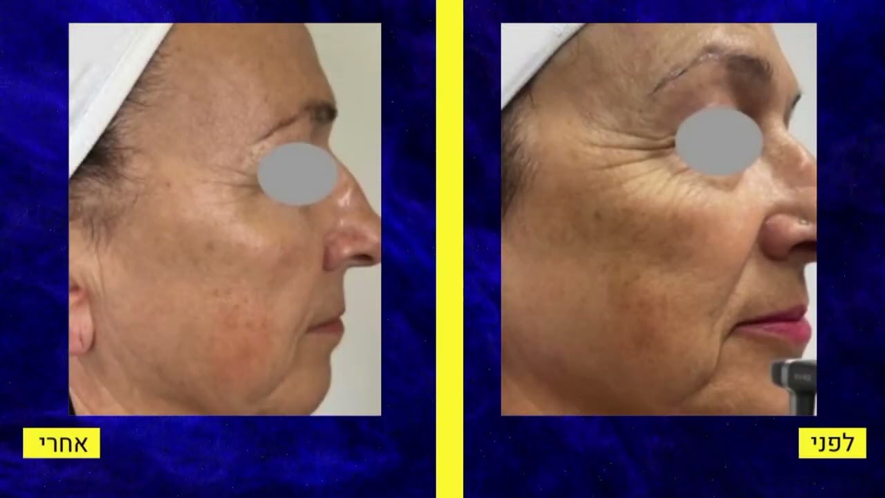 וידאו אחד thumbnail