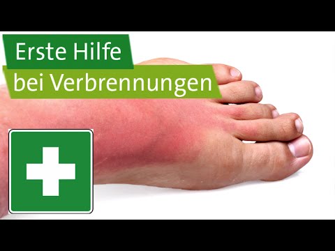 First aid for burns