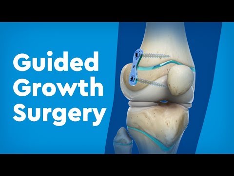Guided Growth Surgery for Limb Deformities