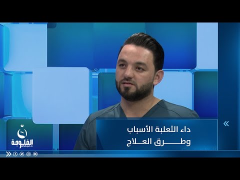 شاهد بالفيديو.. داء الثعلبة الأسباب وطرق العلاج