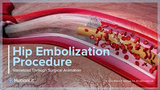 Hip Embolization Procedure Visualized Through Surgical Animation