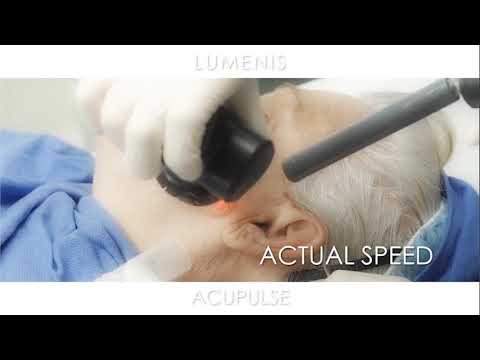 Dr. Daniel Friedmann Treatment Advice with AcuPulse | Lumenis