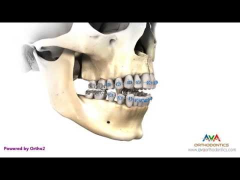 Surgical Orthodontic Treatment for Openbite - Maxillary Impaction
