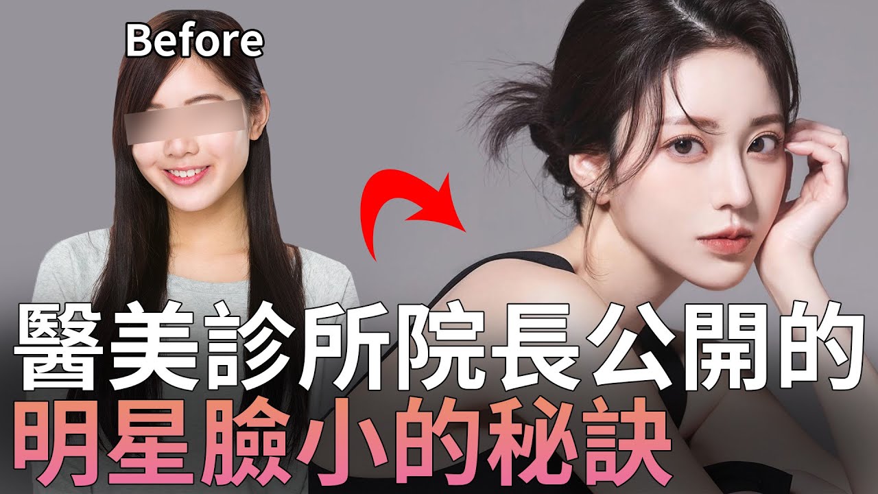 인모드 멍 왜 생길까, FX·Forma·포텐자 DDR 차이
