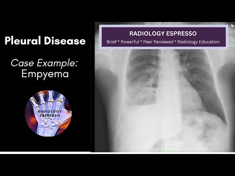 PLEURAL DISEASE: Case Example - Empyema