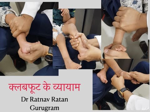 क्लबफूट के व्यायाम|Clubfoot exercises|क्लबफूट में कैसे बचें आपरेशन से|Dr Ratnav Ratan #CTEV#clubfoot