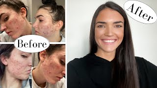 How I Cleared My Acne Naturally!