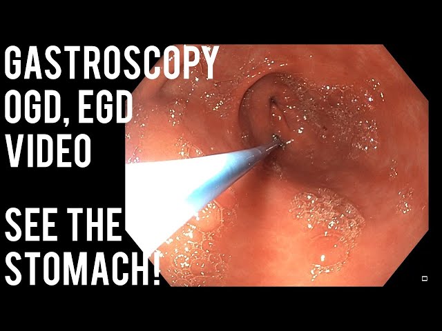 Videouttalande av esophagogastroduodenoscopy Engelska