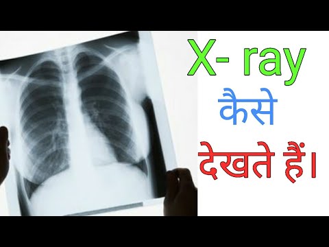 How to read Chest X-ray || Hindi language