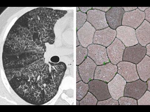 CT CHEST V16 HIGH ATTENUATION AND LOW ATTENUATION LESIONS (CYST, BULLA, EMPHYSEMA AND CAVITY)