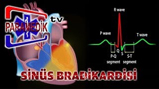 EKG - SİNÜS RİTMLERİ : Sinüs Bradikardisi