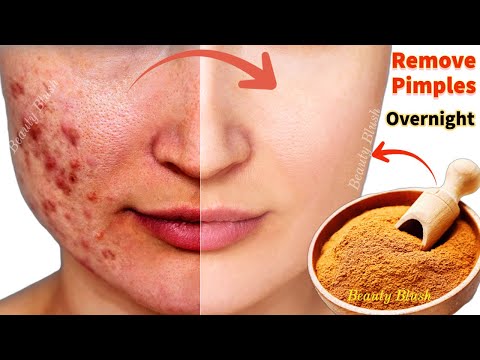 How To Remove Pimples Overnight | Acne Treatment | Remove Acne Pimples Fast Easy & Effective