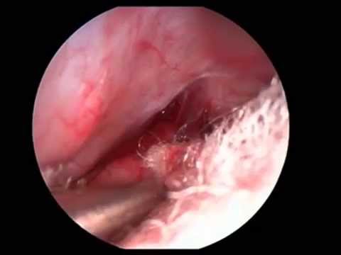 Overeyeball  Endoscopical  Access To The Anterior Cranial Fossa For Base Correction