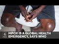 Mpox: First case of contagious variant outside Africa reported
