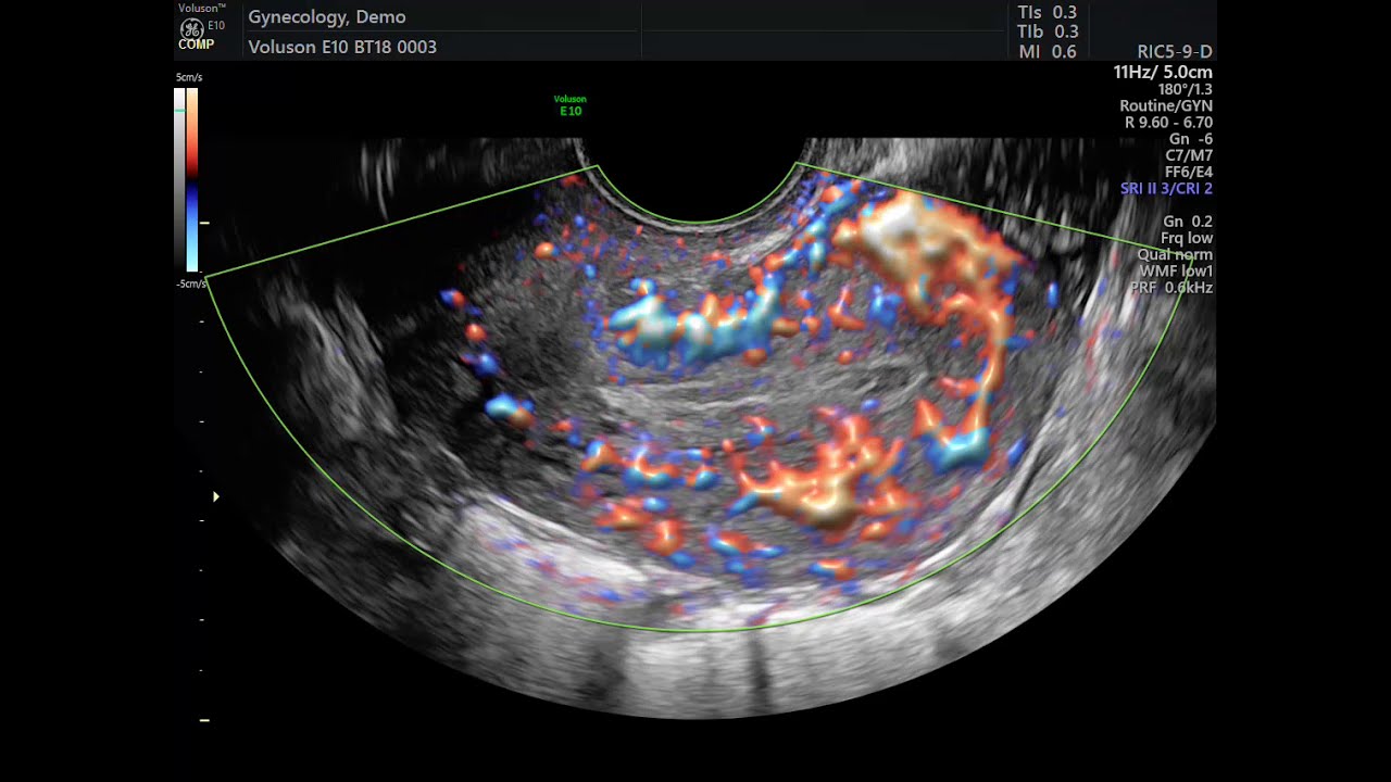 AVALIAÇÃO DE CIRCULAÇÃO UTERINA EM ULTRASSON ENDOVAGINAL