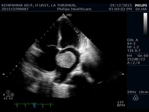 Left Atrial Myxoma