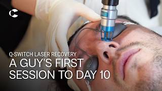 Martin's Q-Switch Laser Recovery - First Session to Day 10