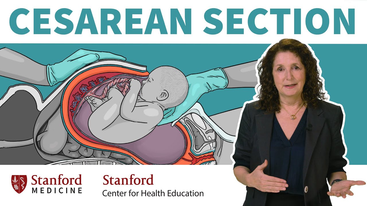 What is a cesarean section? OB/GYN answers 13 common questions about c-sections | Stanford