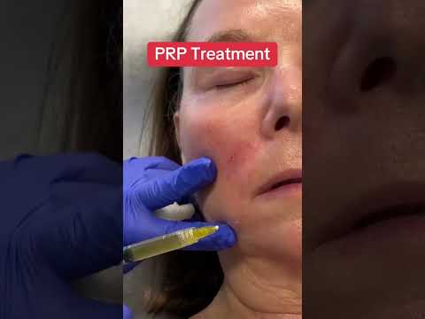 How a PRP Treatment Works #prp #prf #wrinkletreatment