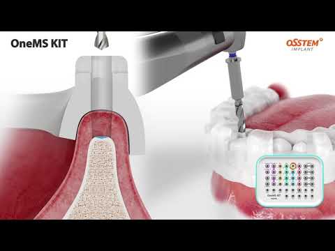 OneMS KIT: OneGuide System for Narrow Bone Surgery