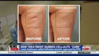 New tool to fight cellulite health FDA approved procedure maybe a long term solution