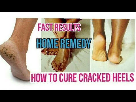 How to cure Cracked Heels Fast | Home Remedy | Dry and Painful Cracked Heels Fast Recovery Video