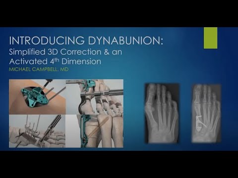 Introducing DynaBunion™ - FOOTInnovate Webinar with Michael Campbell, MD