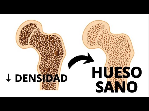 COMO GANAR DENSIDAD OSEA Y PREVENIR OSTEOPOROSIS EN 3 PASOS
