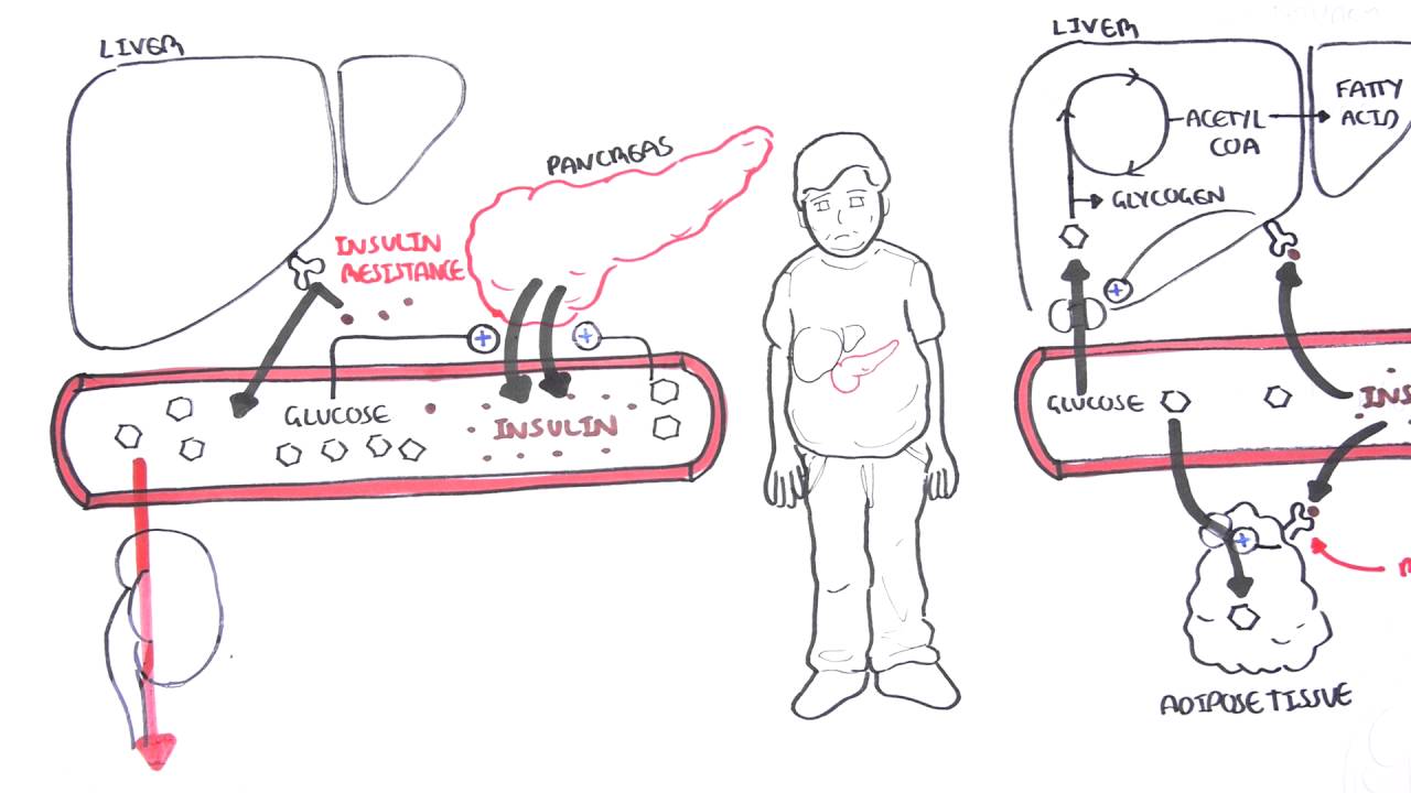 Diabetes Type II Pathophysiology