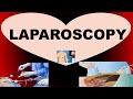 Laparoscopy : Indications, Contraindications, Procedure, Post Operative Care and Complications