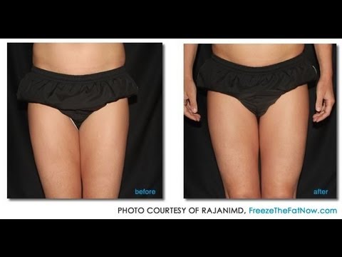 CoolSculpting-What Results Can I Expect