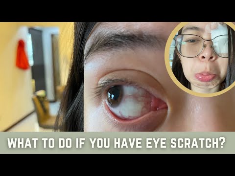 First Aid for Corneal Abrasion (Eye Scratch) | Do's and Dont's | Doc Chabi Channel