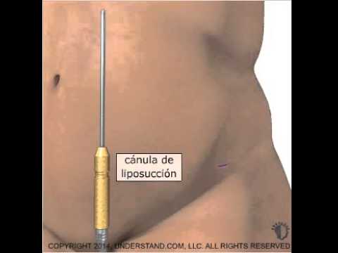 Colombia Liposuction Unveiled: Costs, Recovery Tips & Technique Breakdown