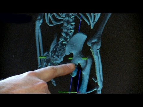 Elephant Man's Walk: Meet The Elephant Man