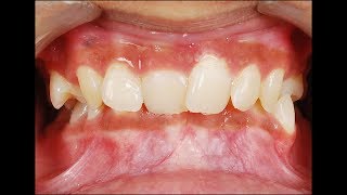 #Braces #Smile Braces (Orthodontic Treatment) Journey Before & After Transformation