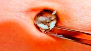 Popping Navel Stones!   Belly Blackheads?