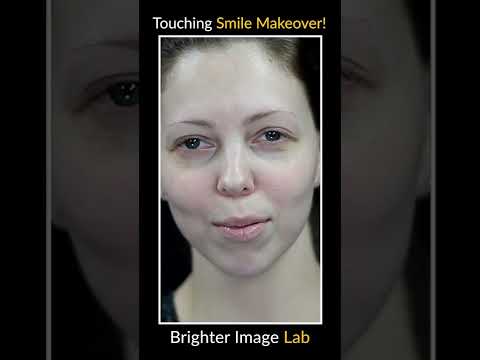 Big Teeth Fix - Dental Veneers by Brighter Image Lab are the Easy Solution for Big Teeth