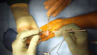 preview picture of video 'Mucous Cyst Excision Surgery by Pearland Surgeon Dr Jeffrey E Budoff'